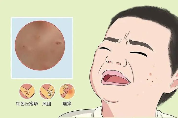 孩子结节性痒疹怎么办，家长应注意以下几方面 - 知乎