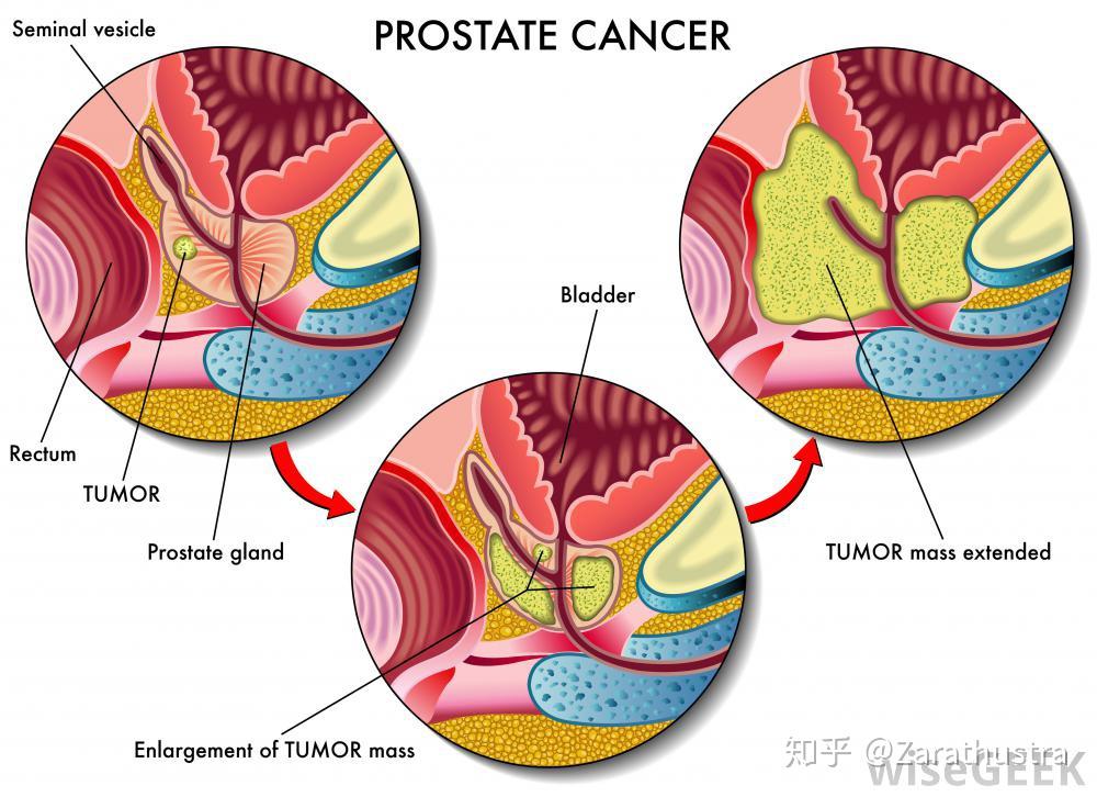 根治性前列腺切除术(radical prostatectomy)