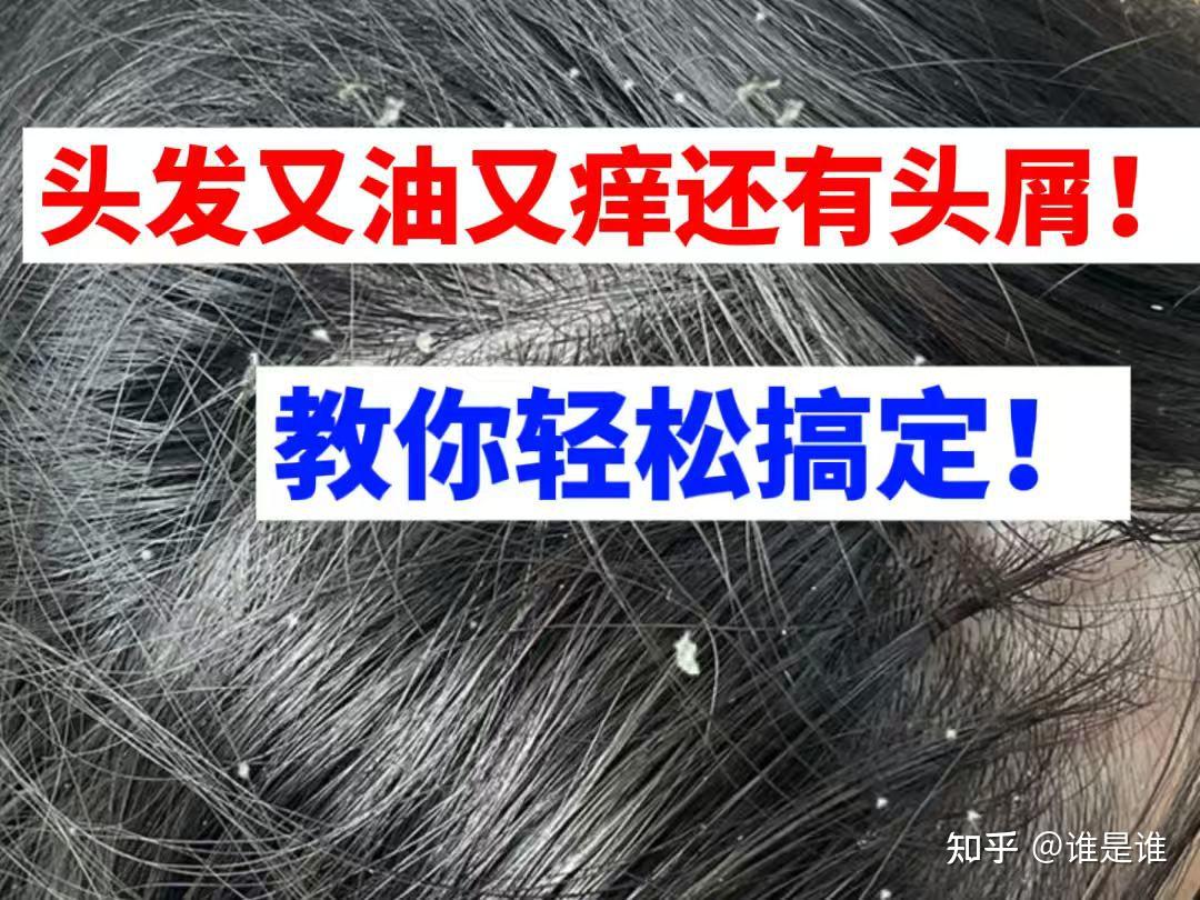 头屑痒到想换头?!拯救千万人的方法你还不知道?看完头屑头痒全消失! - 知乎
