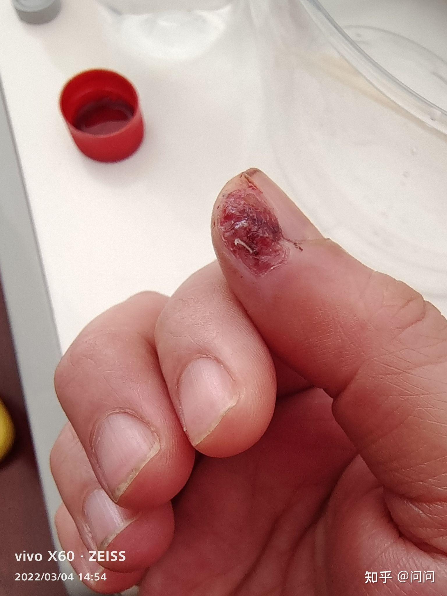 手指切伤后长好以后会变回原来的样子吗