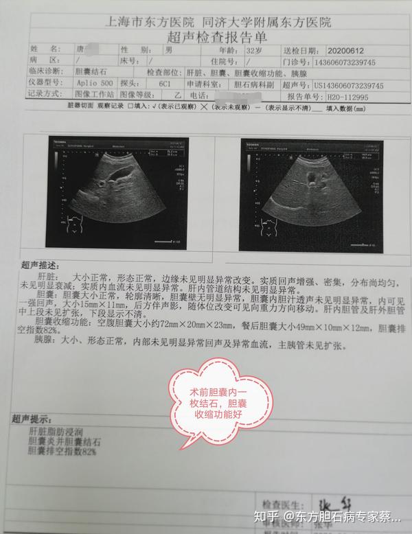 保胆取石术后胆囊功能可以恢复正常