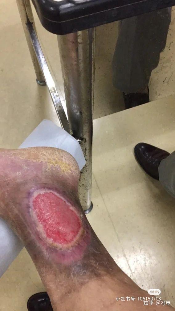 老烂腿怎么治——从日常调理到专业治疗