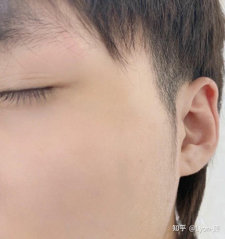 男生油性皮肤夏天爆痘,毛孔粗大有黑头,要如何护肤? - 知乎