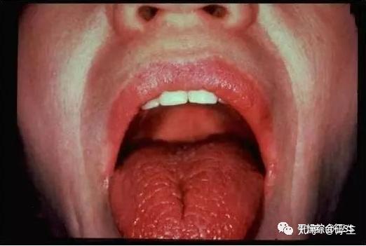 干燥综合征的主要表现和易发人群