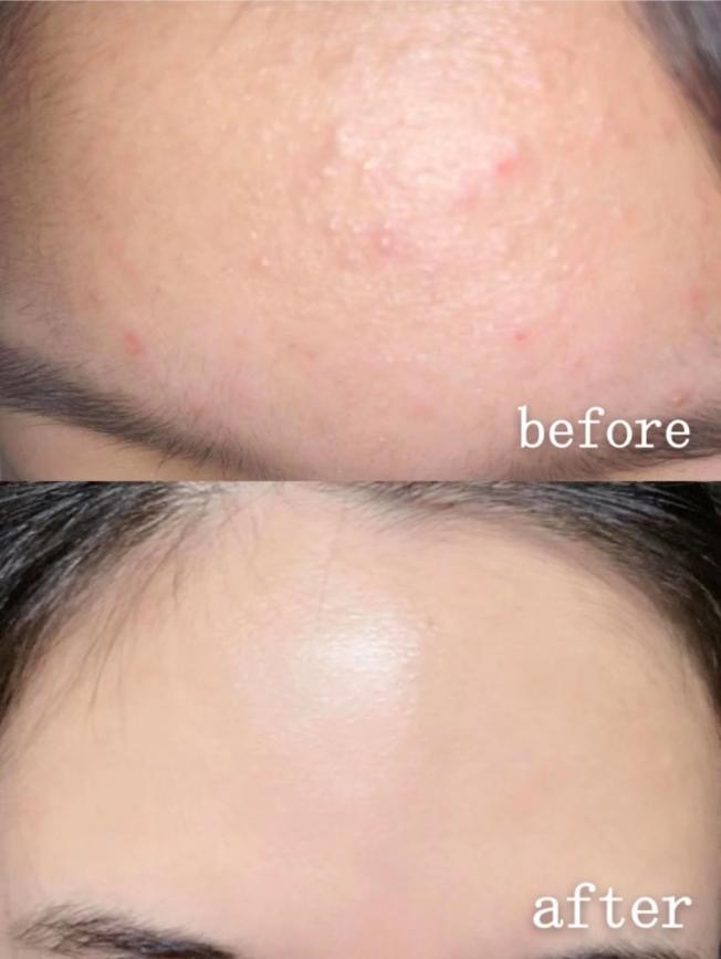 闭口黑头怎么去除? - 知乎