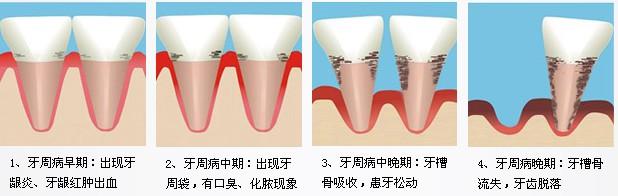 牙龈肿痛、出血,真的是上火吗? - 知乎