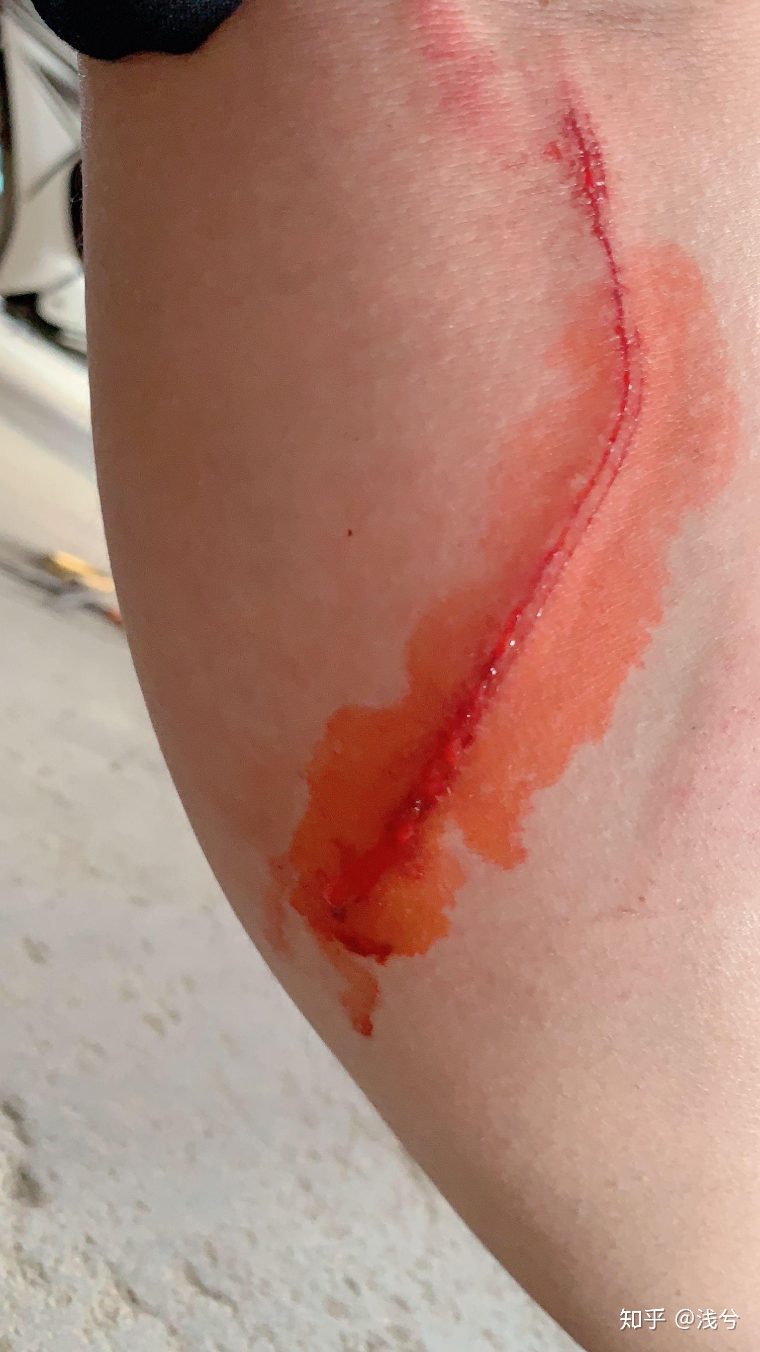 腿摔伤成这样自己在家该怎么弄才会好的得快? - 知乎