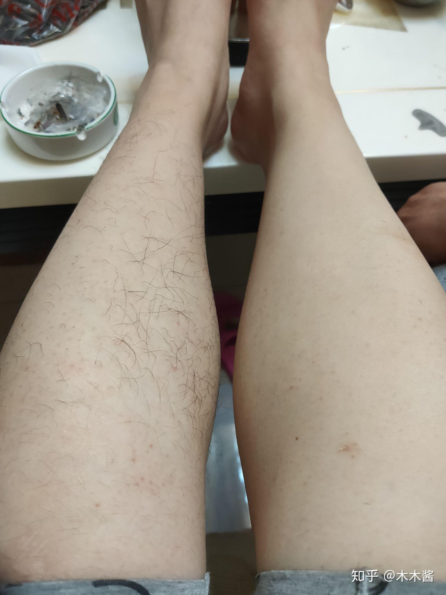 腿毛长的女生一定要脱毛吗?