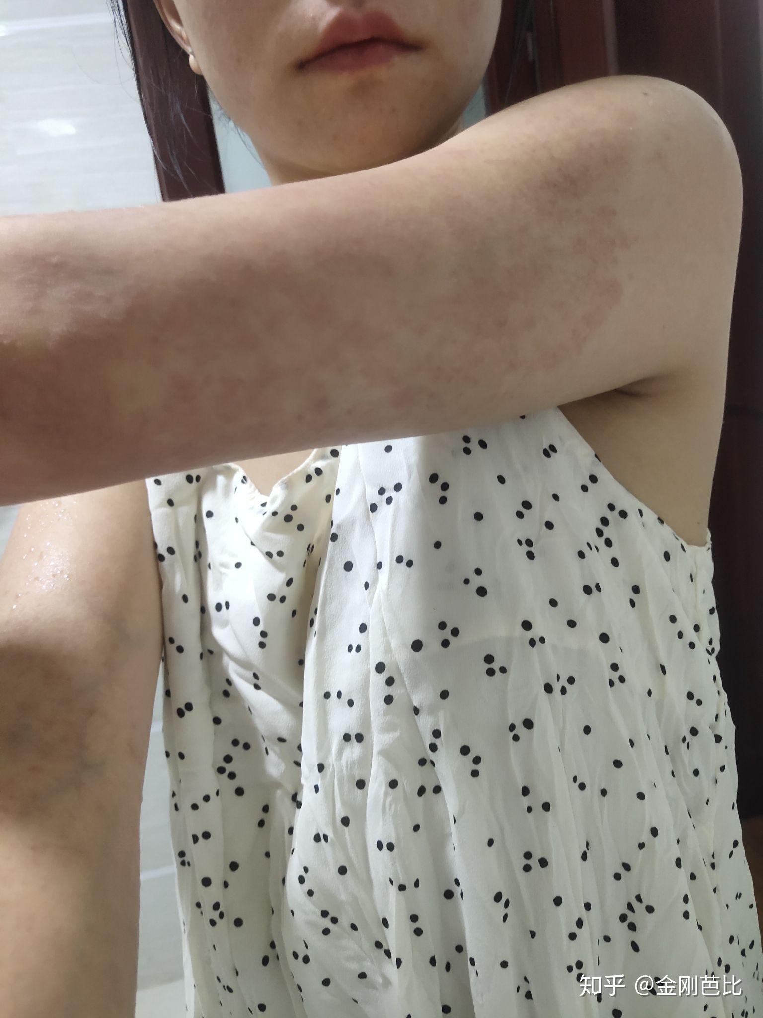 得了多形性红斑,怎么才能痊愈啊?要忌什么吗? - 知乎