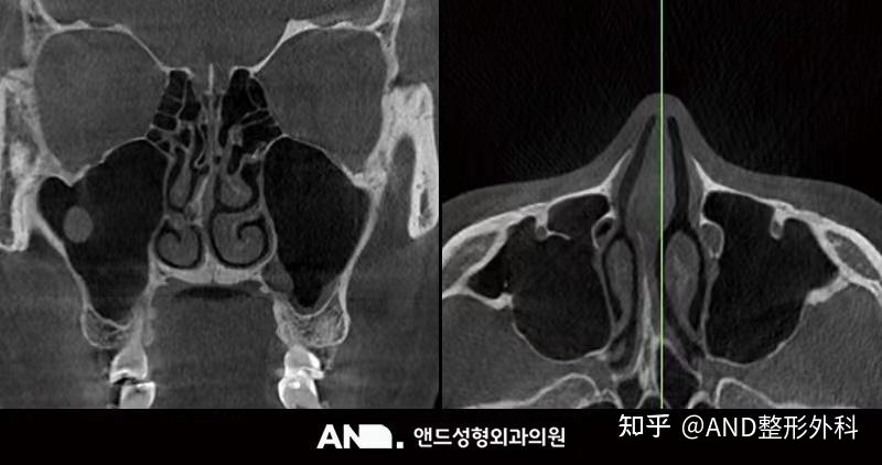矫正龙鼻:鼻孔漂亮才算完美的鼻子 [第一次鼻整形（鼻尖+鼻翼缩小+人中鼻+功能鼻）] 前后事例 - 知乎