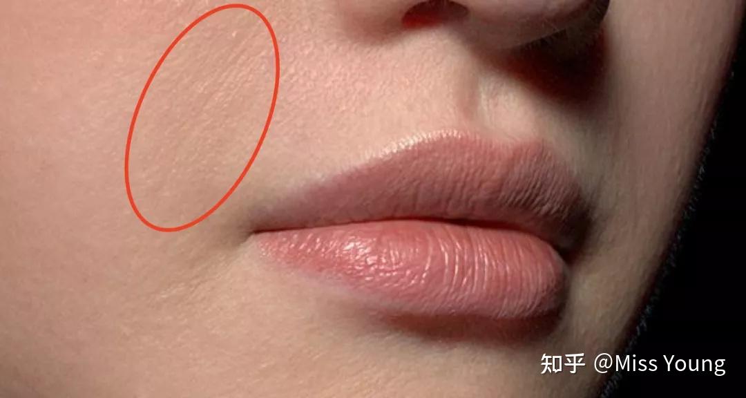 面部皱纹都有哪些种类?形成原因?如何除皱? - 知乎