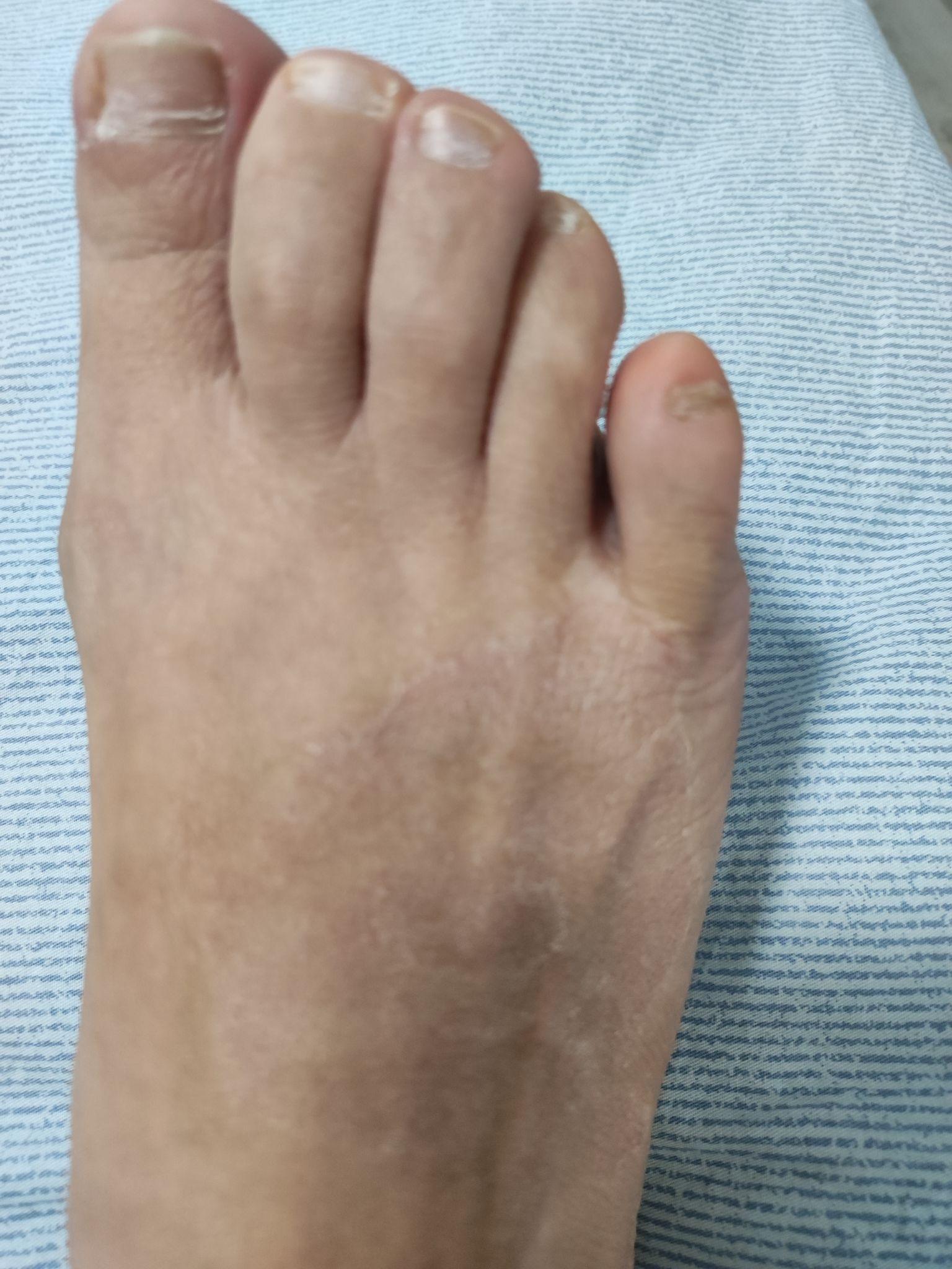 灰指甲治疗记录