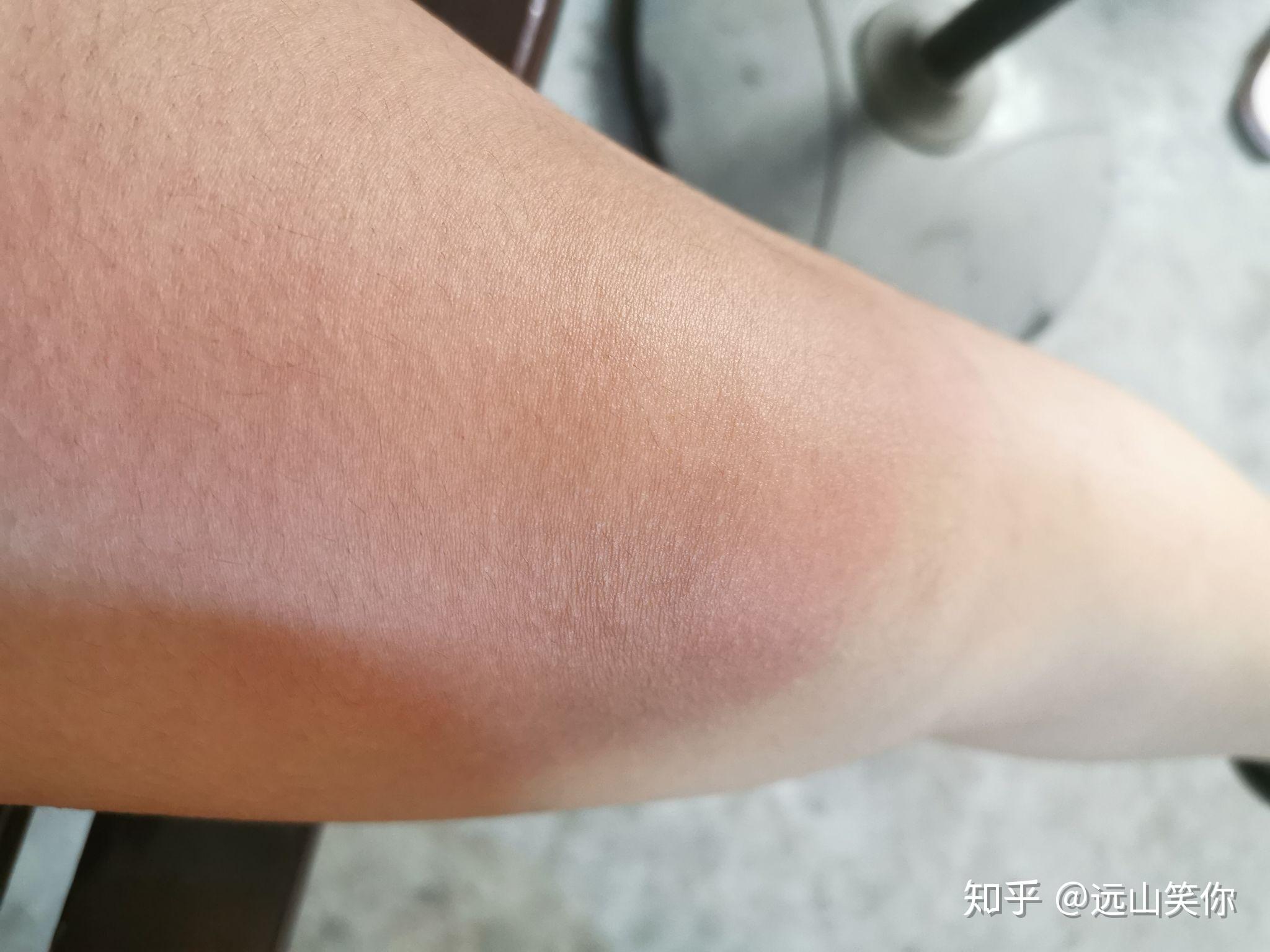 紫外线过敏/日光性皮炎 是一种怎样的感受? - 知乎