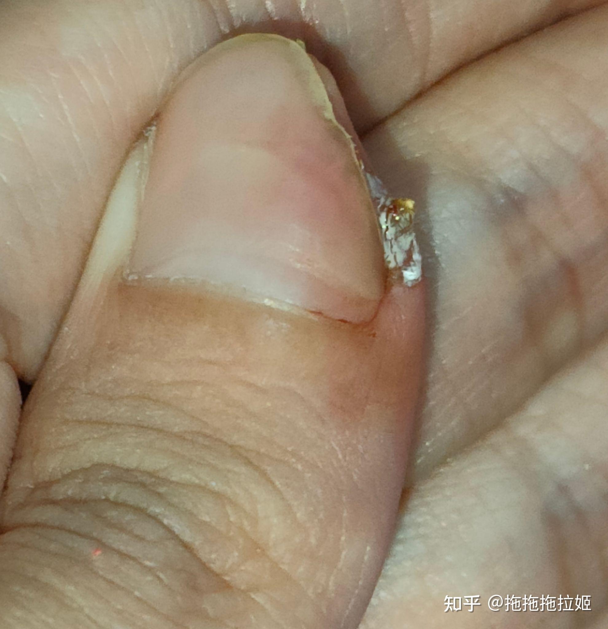 严重的甲周疣,还有救么? - 知乎