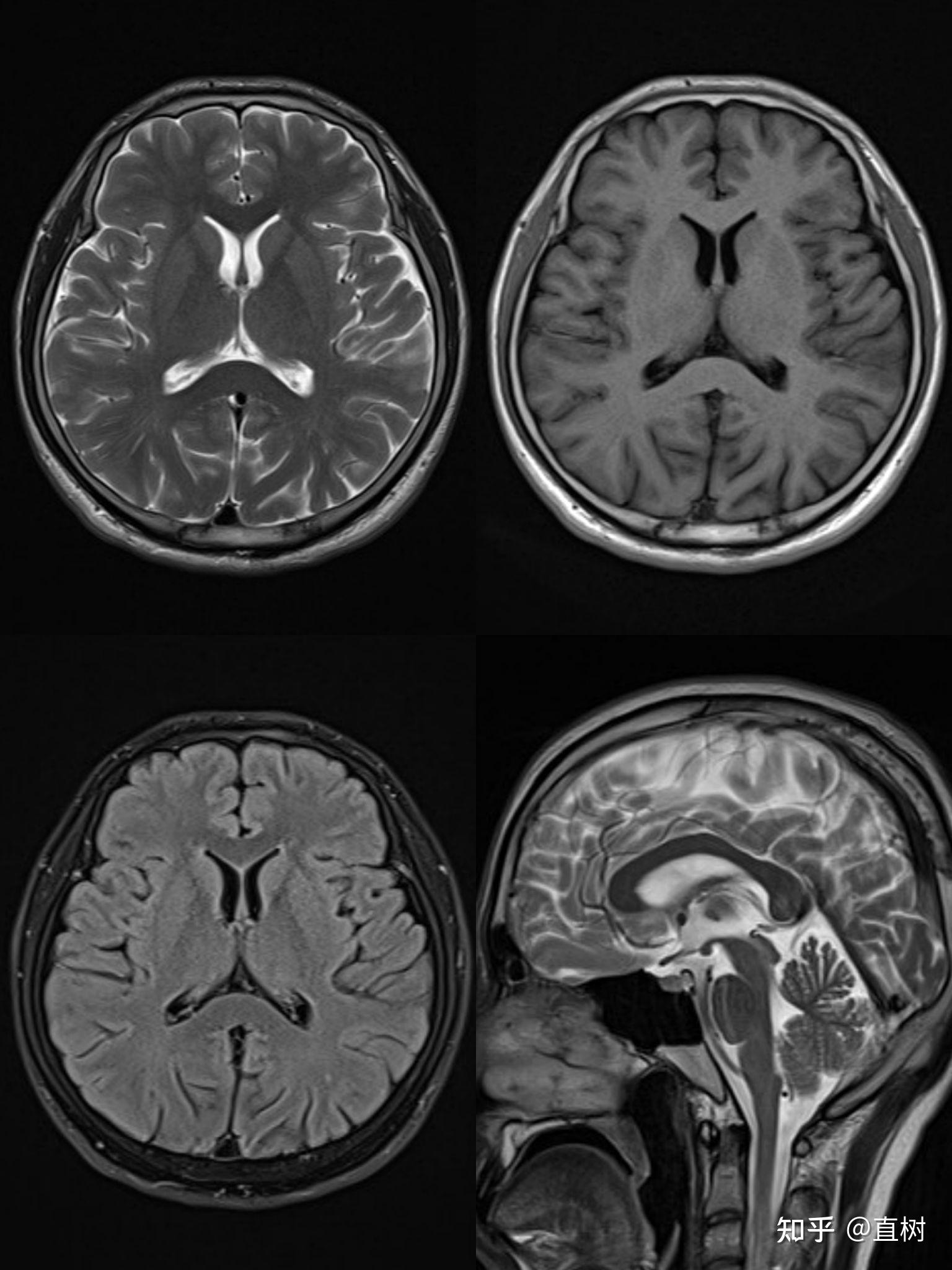 MR图谱 | 放射性脑损伤vs胶质瘤复发-INC国际神经外科医生集团