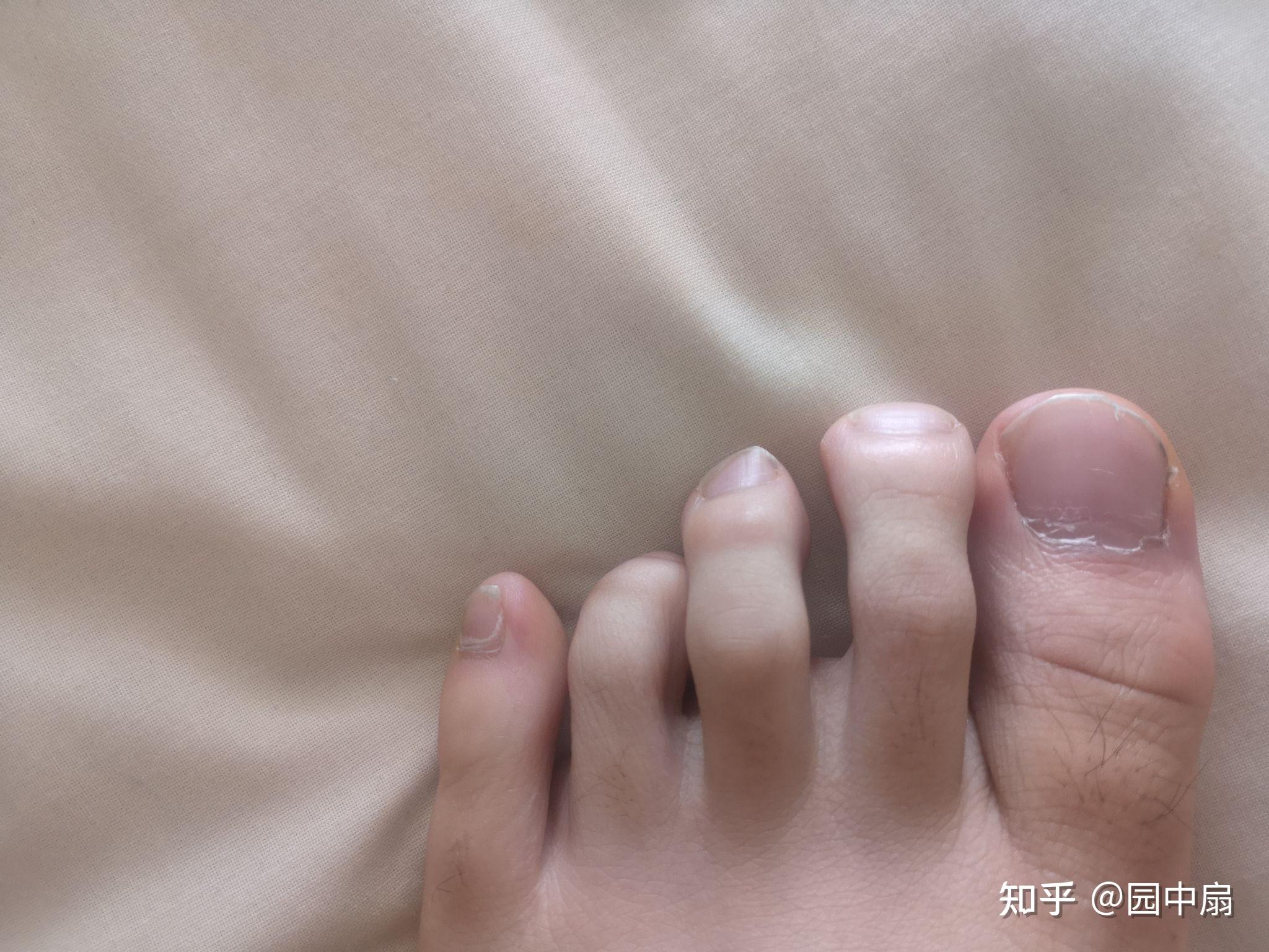 请问有人是第四脚趾短小症吗