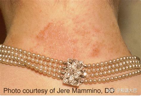 金属过敏是种什么样的体验?