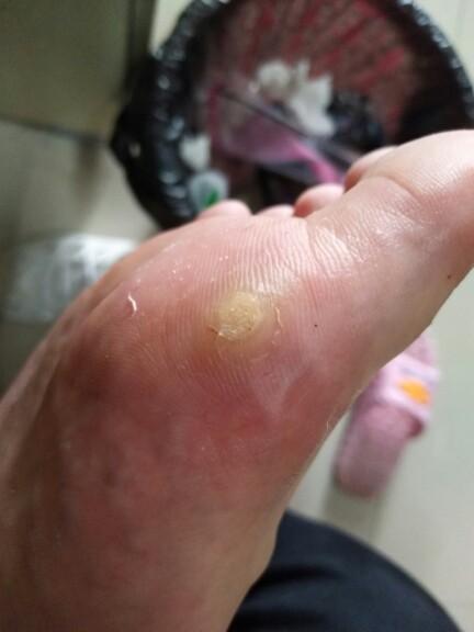 脚上大拇指旁边好像磨出了一个疙瘩?这是老茧吗? - 知乎