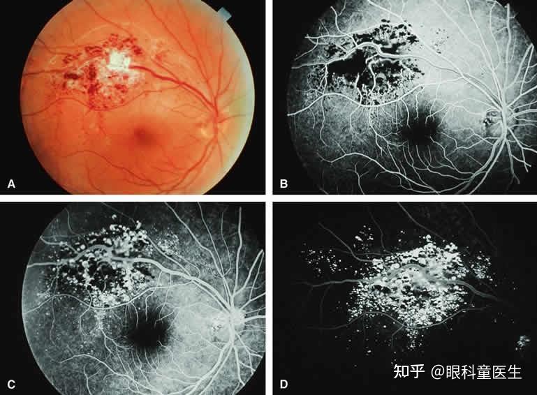 视网膜肿瘤性疾病3视网膜海绵状血管瘤