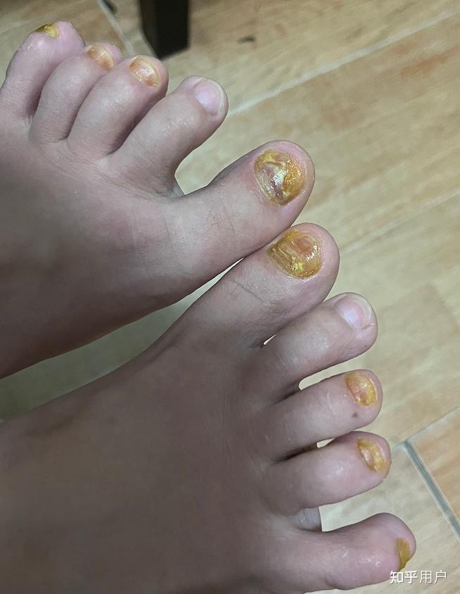 灰指甲真的很难治愈吗尤其是脚上的灰指甲