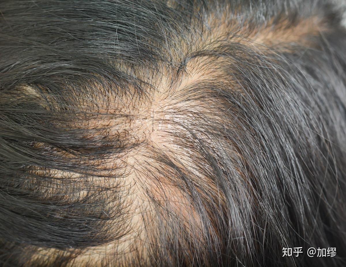 弥漫性脱发成因和再生步骤