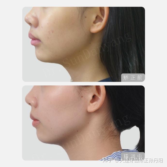 大连牙齿矫正骨性下颌后缩代偿性治疗案例