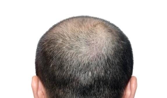 光头养头发 脱发后是否应该剃光头 知乎 光头养头发 脱发后是否应该剃光头 知乎