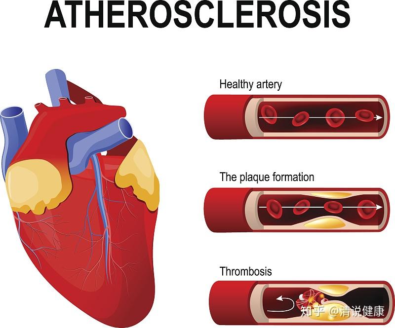 90后夫妻双双查出高血脂医生只因一种食物吃太多血管受不住