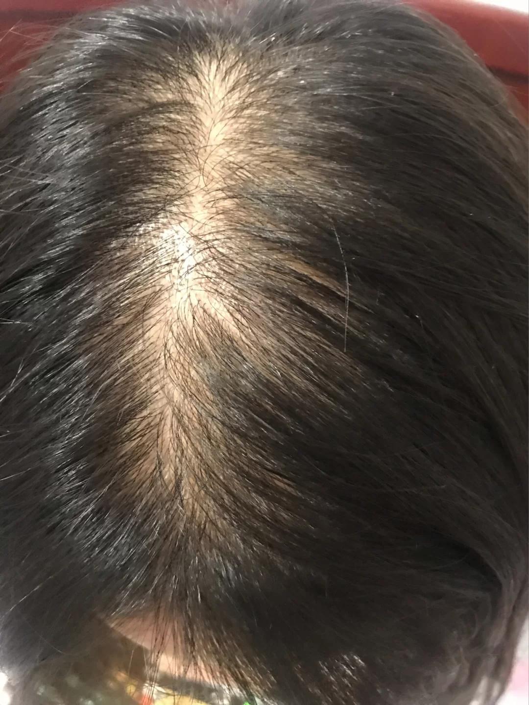 20岁的女大学生如何治疗脂溢性脱发? - 知乎