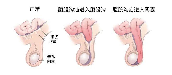 长在娃私处影响生育请重视这个要命的病
