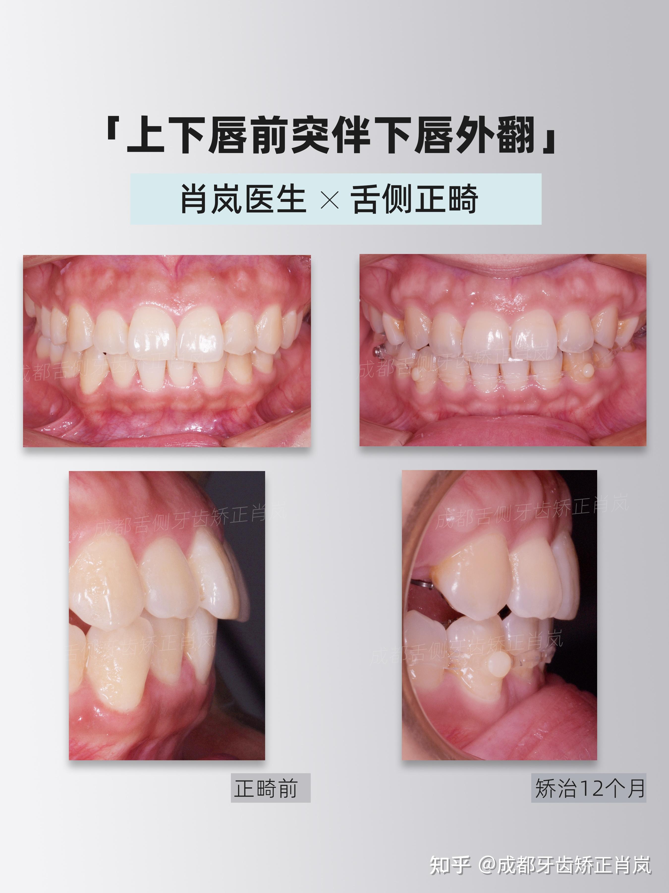 尖牙进行舌侧矫正,内收上下前牙改善侧貌突度及颏部形态,纠正上颌中线