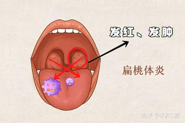 美女扁桃体图片