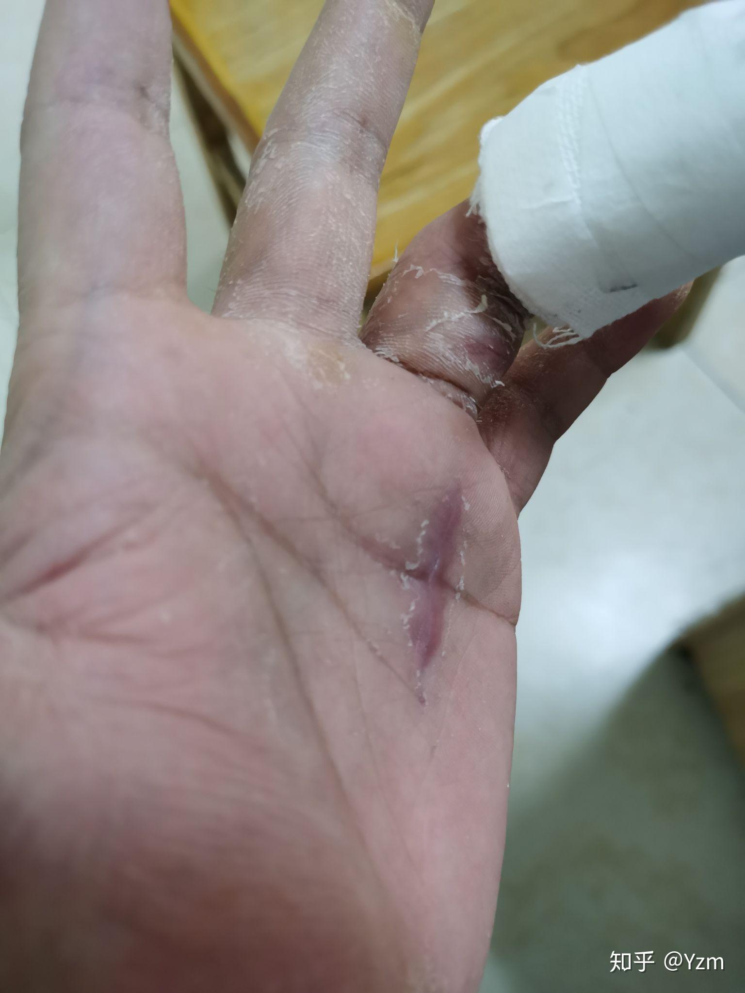 无名指屈肌肌腱断裂术后经历二次断裂生活的绝望从来都让人措手不及