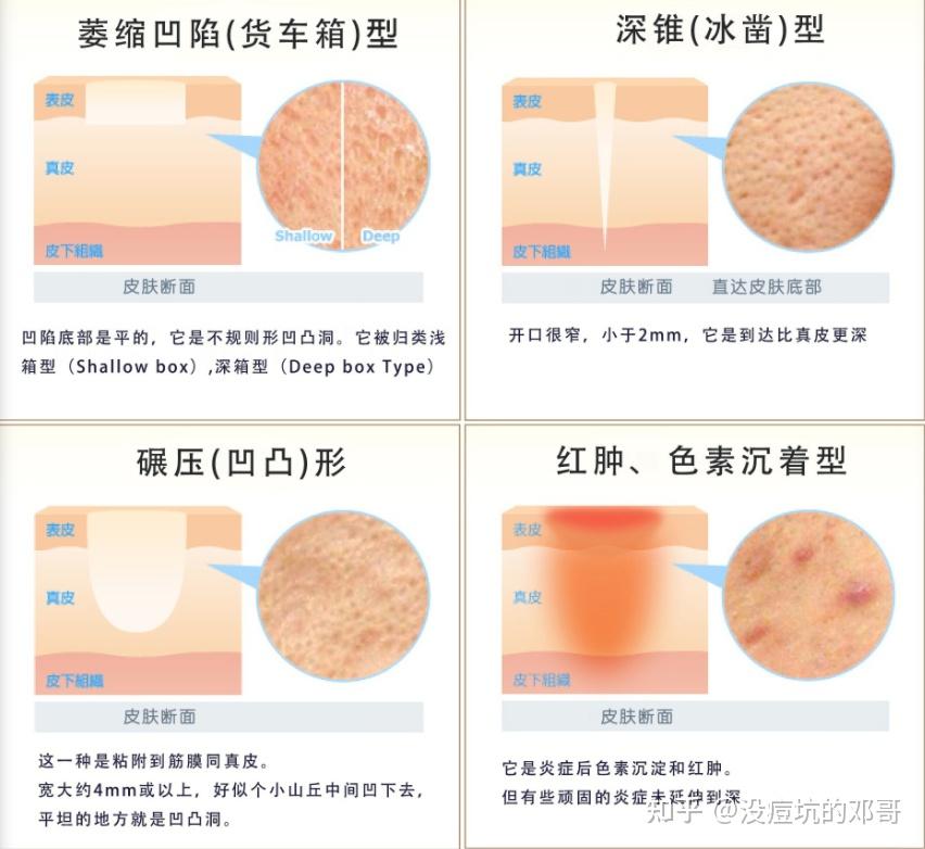 痘坑修复价格