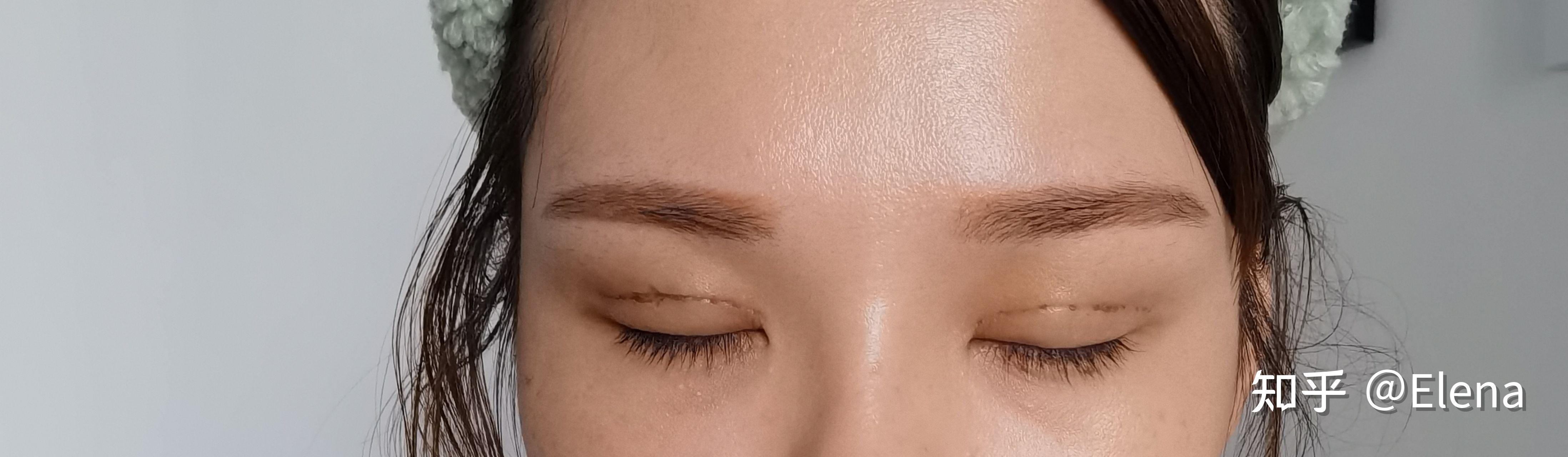 记录一下肿眼泡的埋线双眼皮. - 知乎