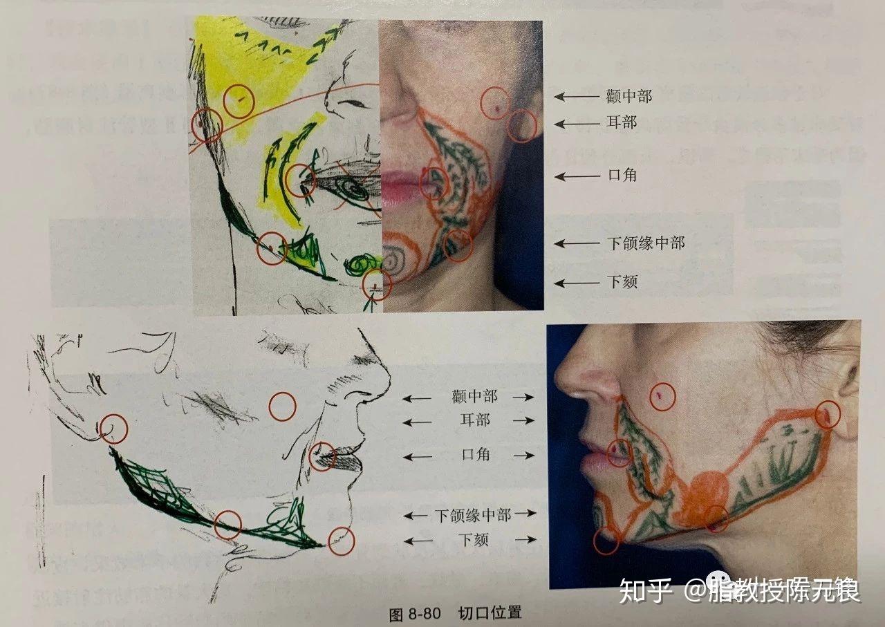 自体脂肪隆颏及下颌缘(医疗专业科普) - 知乎