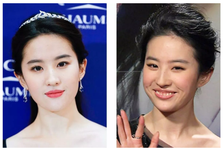 及牙龈的显露量将微笑分为三类, 分别为低位笑线,中位笑线,高位笑线