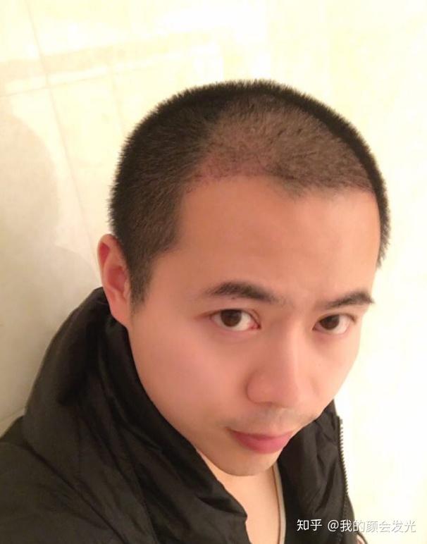 男士植发视频大全(男士植发有什么危害)