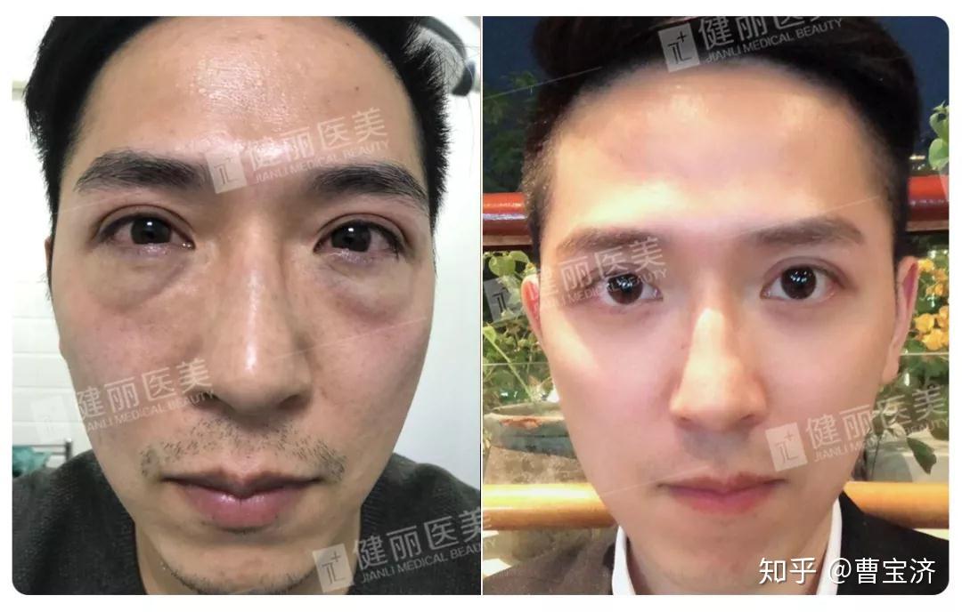 瘦脸打针多少钱_打瘦脸多少钱一次_打瘦脸一般多少钱