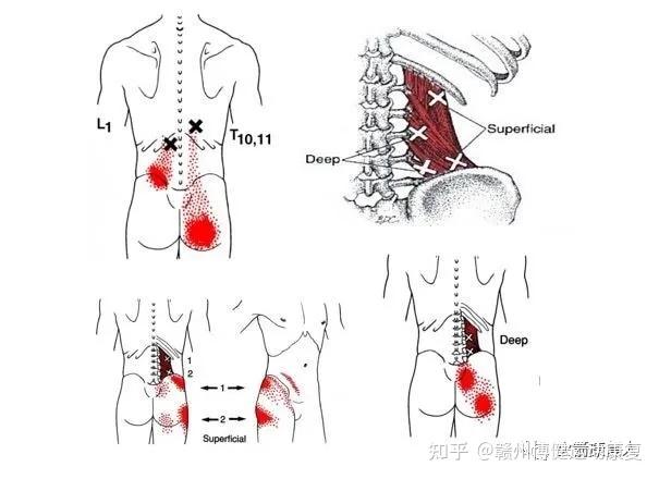 腰方肌激痛点如下:髂腰肌激痛点如下:1,两块引起腰痛最重要的肌肉(腰