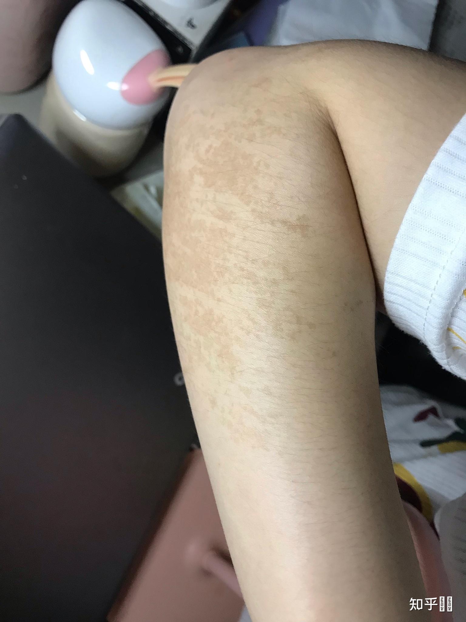 色素性毛表皮痣是一种怎样的病?能否治愈? - 知乎