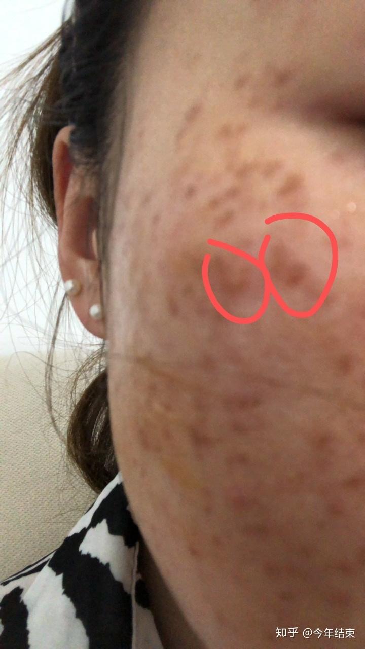 做皮秒的恢复过程一