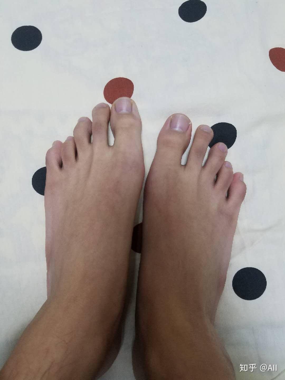 请问有人是第四脚趾短小症吗? - 知乎