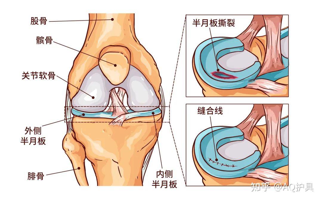 半月板是什么部位图片