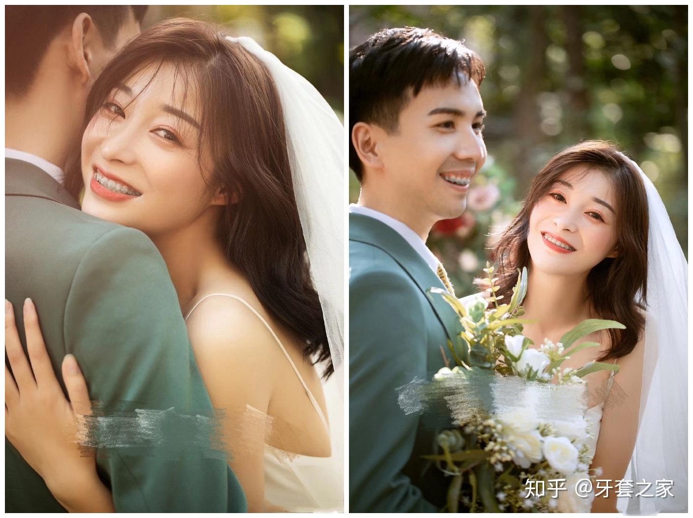 牙套夫妻戴着牙套拍婚纱照是种怎样的体验