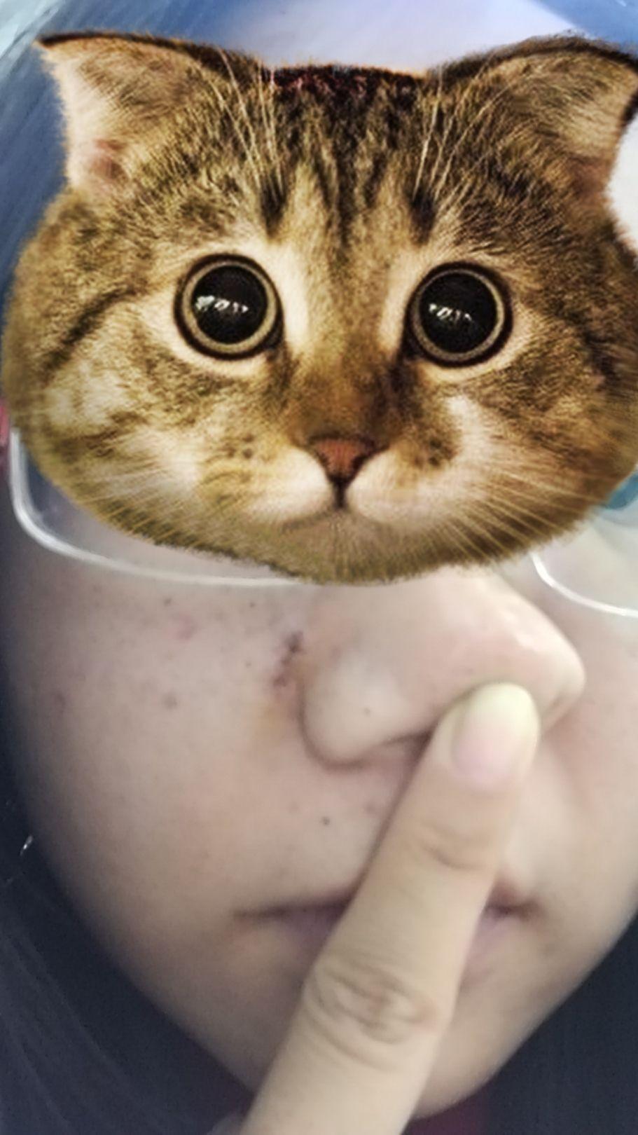 祛痣那些事儿:成都,激光祛痣+手术切痣