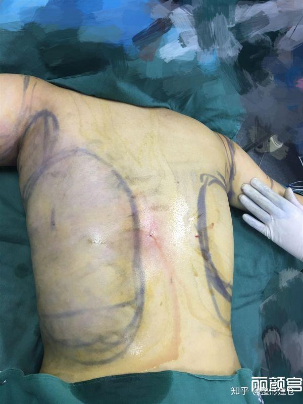 虎背肉肉整顿后背抽脂术前术后瞬间对比照