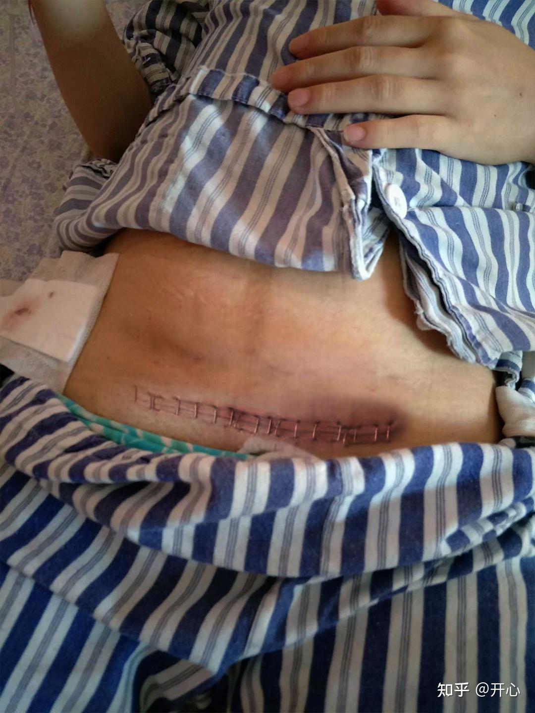 横切剖腹产,产后伤口疤痕以上的肚子总是一堆肉,自己其实已经是瘦的了