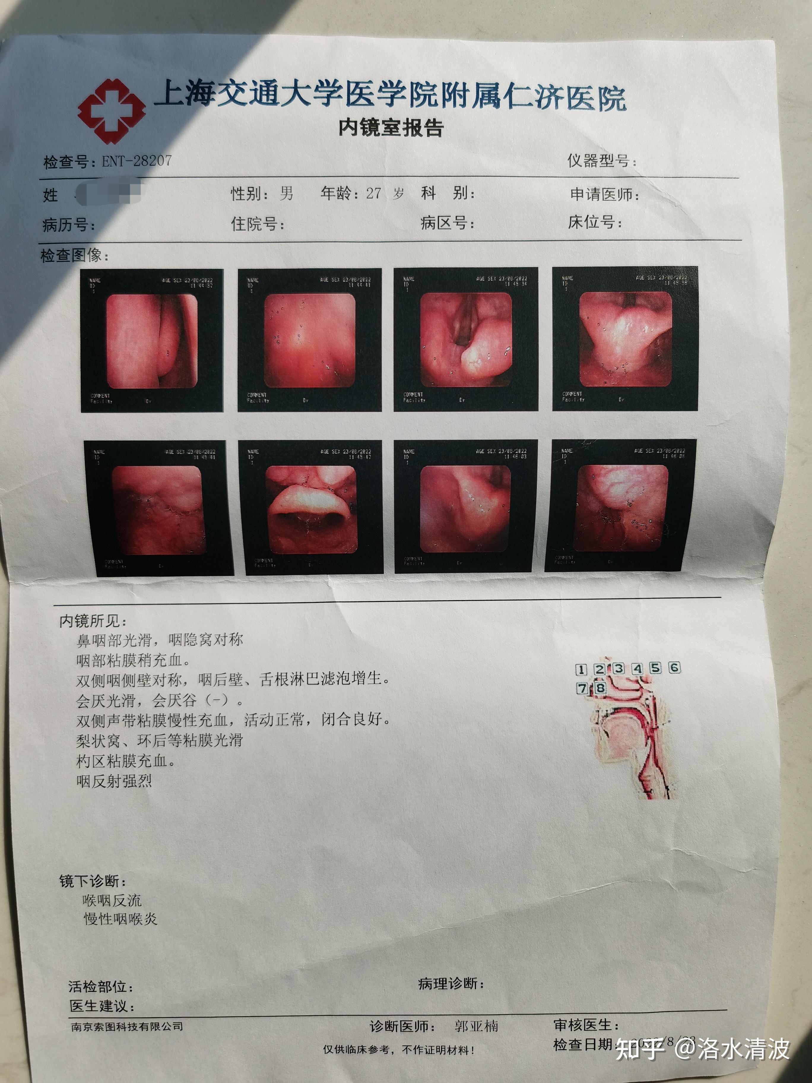 反流性咽喉炎的治疗经历,持续更新