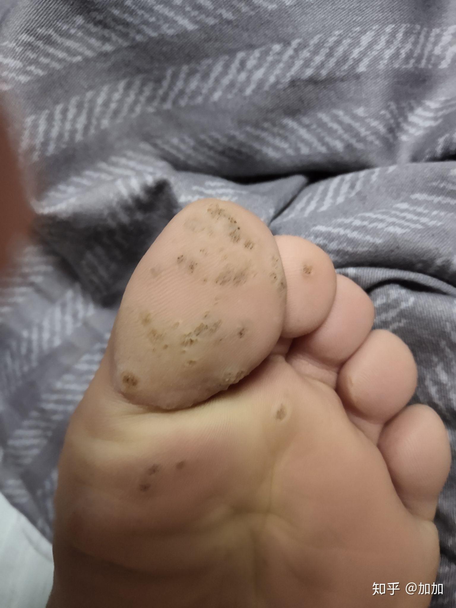 如何去除脚底上的疣